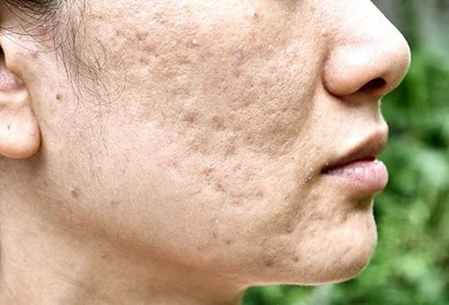 seamoss gel on acne