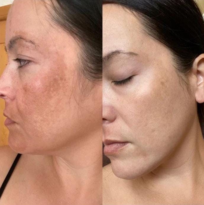 Hyperpigmentation Soap (Offer)