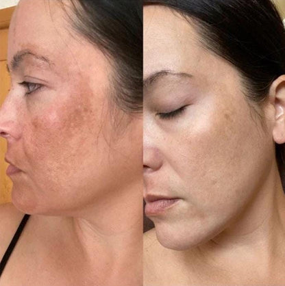 Hyperpigmentation Soap (Offer)