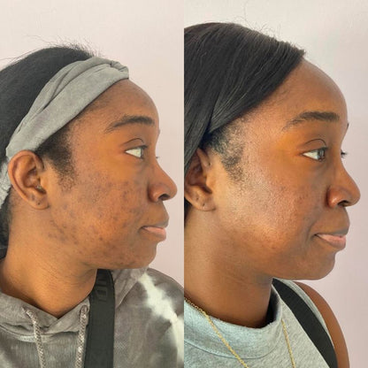 Hyperpigmentation Soap (Offer)