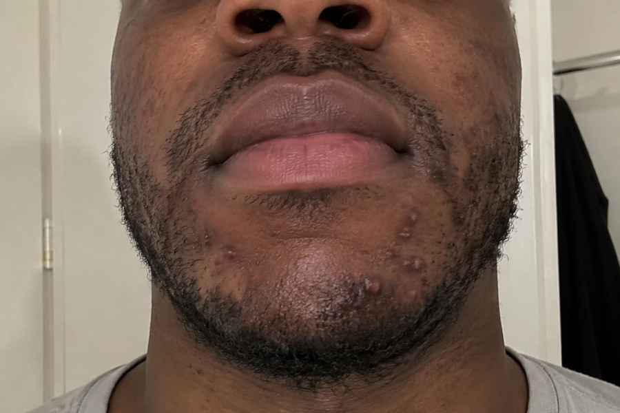 Before — 